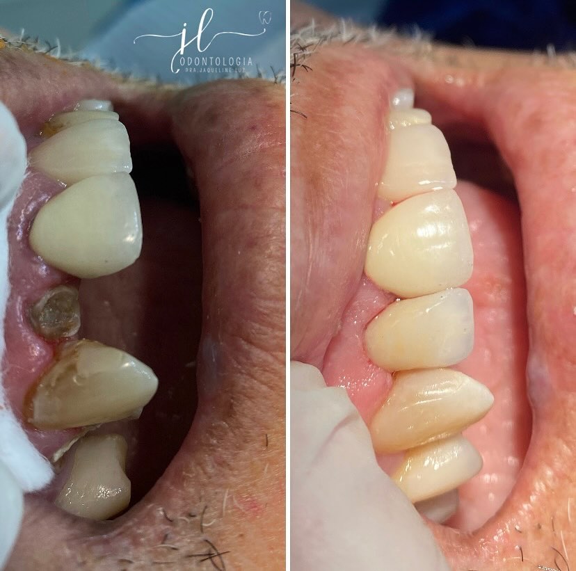 Reabilitação Estética — antes e depois